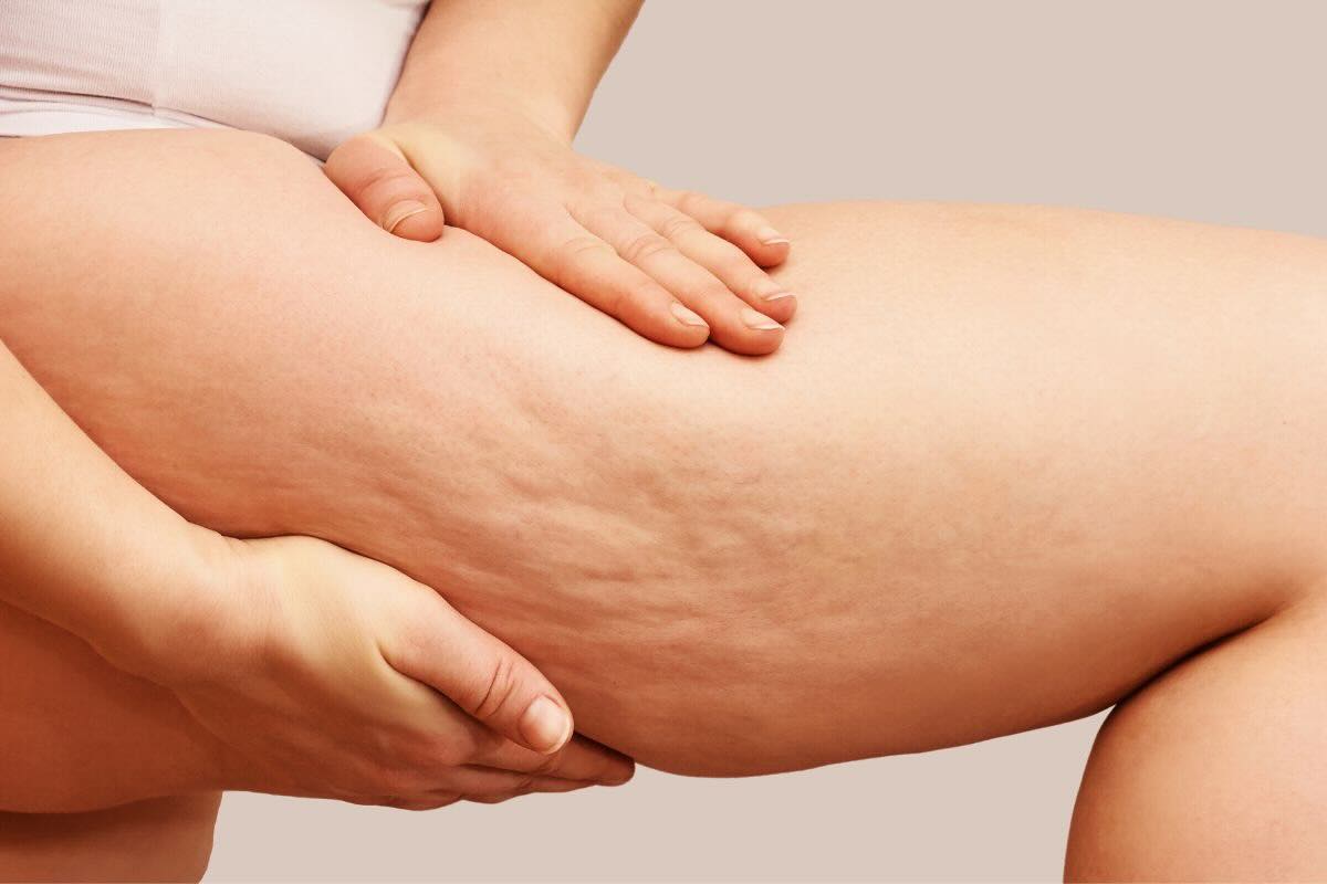 Cellulite gamba